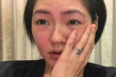 換季皮膚過敏怎么辦？六大致敏誤區(qū)!